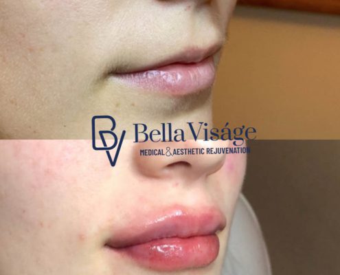 bella-visage-dermal-fillers-ba-1