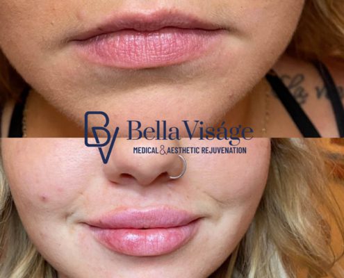 bella-visage-dermal-fillers-ba-10