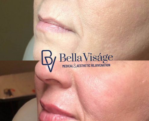 bella-visage-dermal-fillers-ba-2