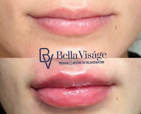 bella-visage-dermal-fillers-ba-3