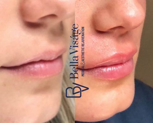 bella-visage-dermal-fillers-ba-4