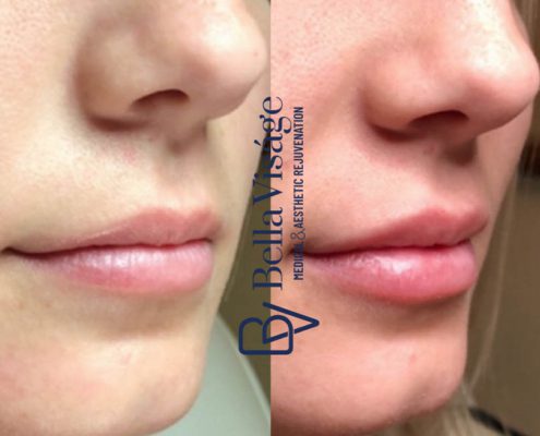 bella-visage-dermal-fillers-ba-5