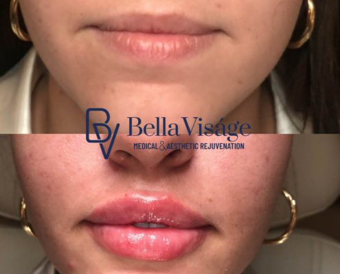 bella-visage-dermal-fillers-ba-6