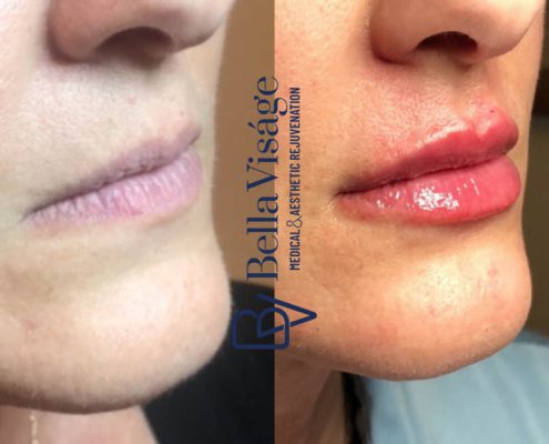 bella-visage-dermal-fillers-ba-7