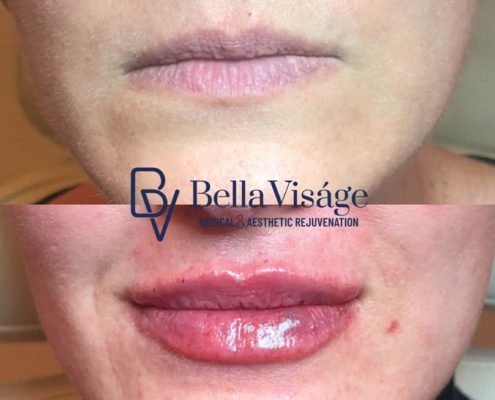 bella-visage-dermal-fillers-ba-8