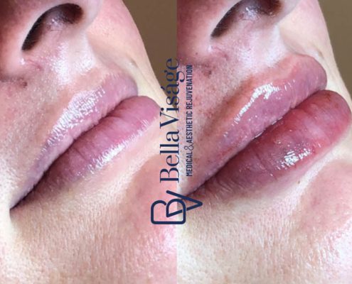 bella-visage-dermal-fillers-ba-9