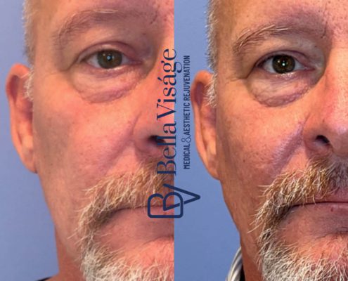 bella-visage-dermal-fillers-face-ba-1