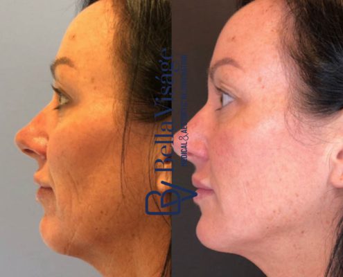 bella-visage-dermal-fillers-face-ba-10