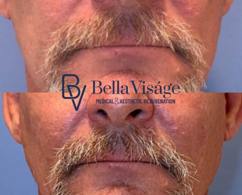 bella-visage-dermal-fillers-face-ba-2