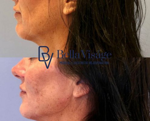bella-visage-dermal-fillers-face-ba-3