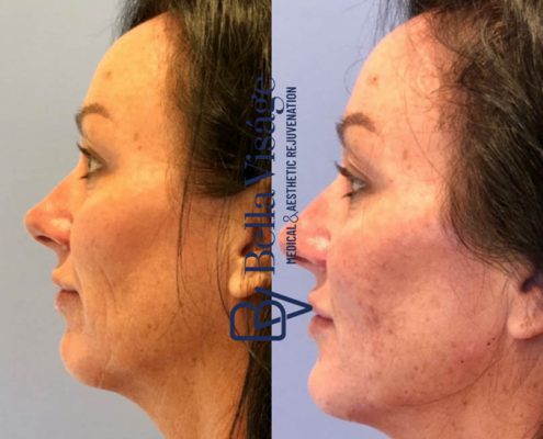 bella-visage-dermal-fillers-face-ba-4