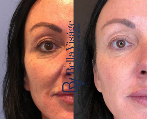 bella-visage-dermal-fillers-face-ba-5