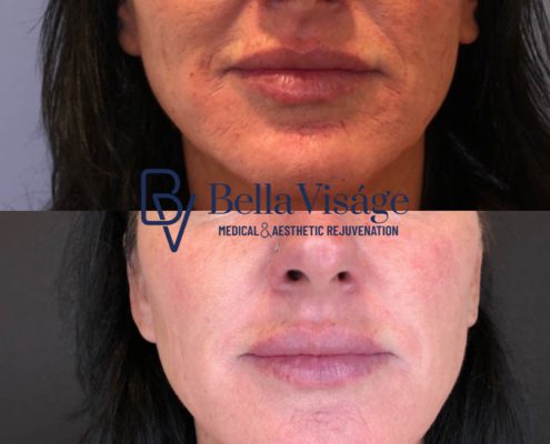bella-visage-dermal-fillers-face-ba-6