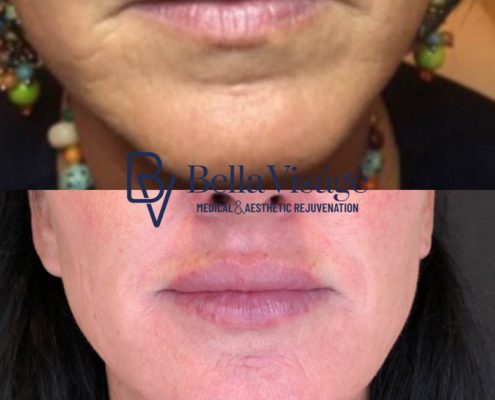 bella-visage-dermal-fillers-face-ba-7