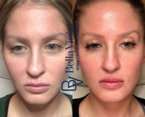 bella-visage-dermal-fillers-face-ba-8