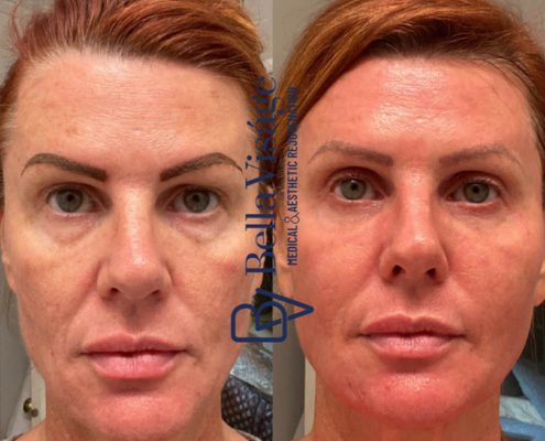 bella-visage-dermal-fillers-face-ba-9