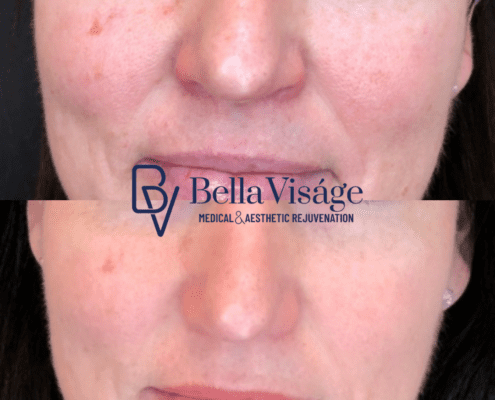 bella-ipl-photofacial-before-after-1