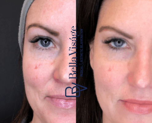bella-ipl-photofacial-before-after-2