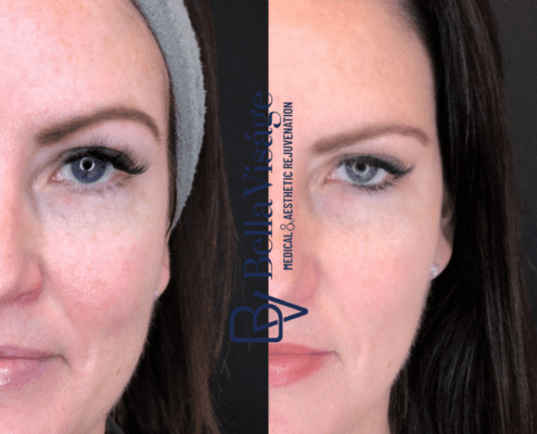 bella-ipl-photofacial-before-after-3