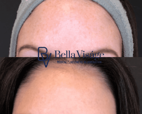 bella-ipl-photofacial-before-after-4