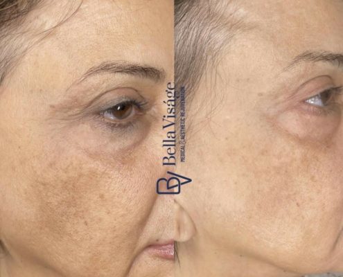Dermapeel-BeforeAfter-Jan24-3