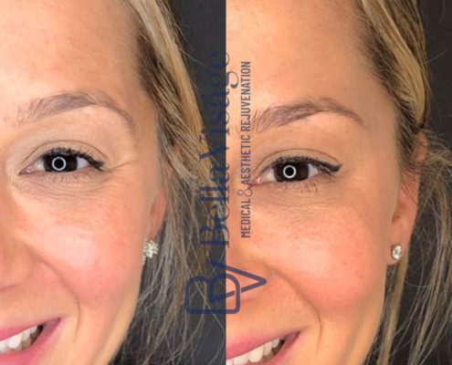 bella-visage-lakeland-neurotoxin-b-a-1