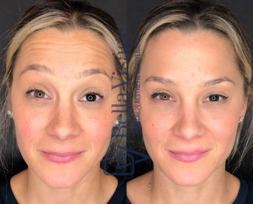 bella-visage-lakeland-neurotoxin-b-a-10
