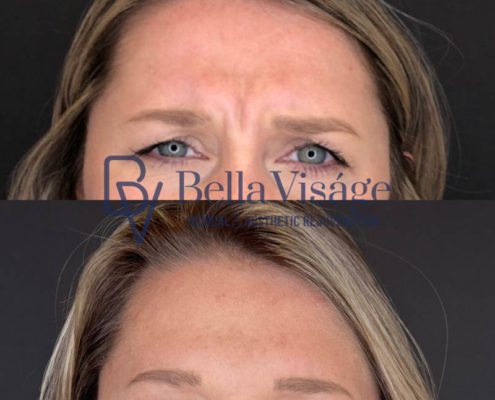 bella-visage-lakeland-neurotoxin-b-a-11