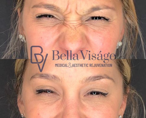 bella-visage-lakeland-neurotoxin-b-a-12