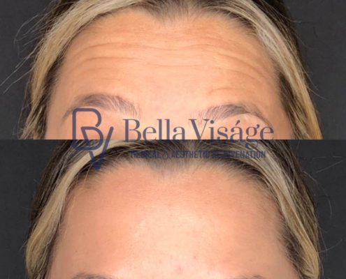 bella-visage-lakeland-neurotoxin-b-a-13