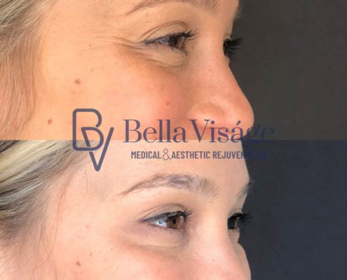 bella-visage-lakeland-neurotoxin-b-a-14