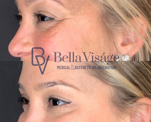bella-visage-lakeland-neurotoxin-b-a-15