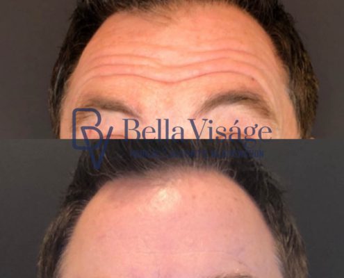 bella-visage-lakeland-neurotoxin-b-a-16