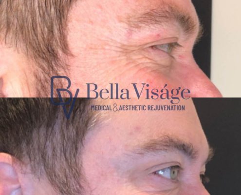 bella-visage-lakeland-neurotoxin-b-a-17