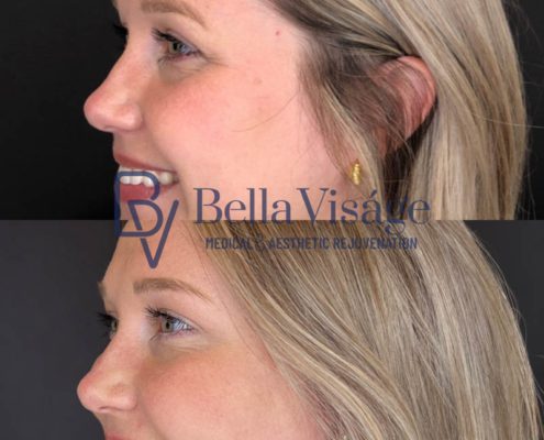 bella-visage-lakeland-neurotoxin-b-a-2