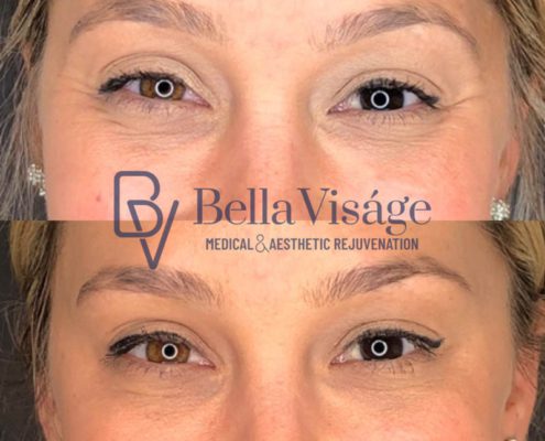bella-visage-lakeland-neurotoxin-b-a-3