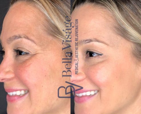 bella-visage-lakeland-neurotoxin-b-a-4