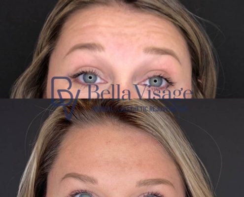 bella-visage-lakeland-neurotoxin-b-a-5