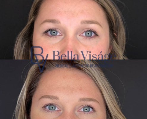 bella-visage-lakeland-neurotoxin-b-a-6