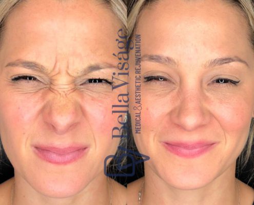 bella-visage-lakeland-neurotoxin-b-a-7