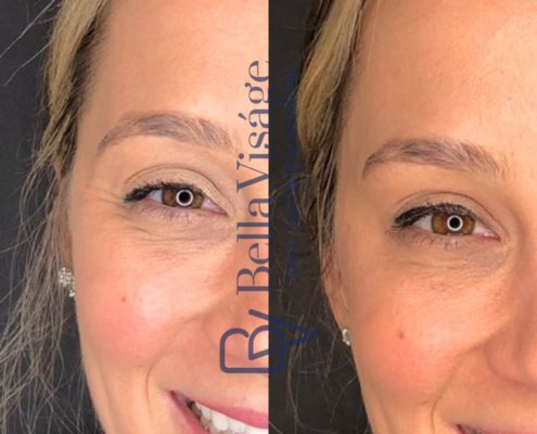 bella-visage-lakeland-neurotoxin-b-a-9