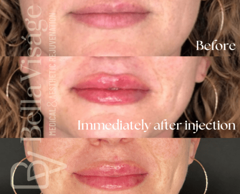 bella-dermalfiller-beforeafter-1