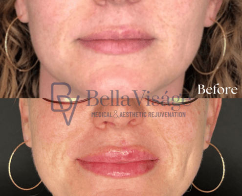 bella-dermalfiller-beforeafter-2