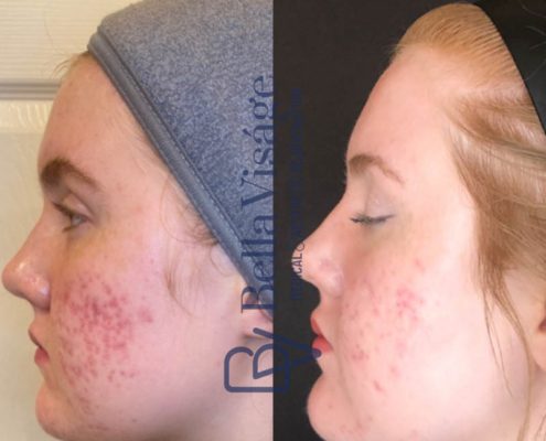 bella-visage-lakeland-rf-b-a-10