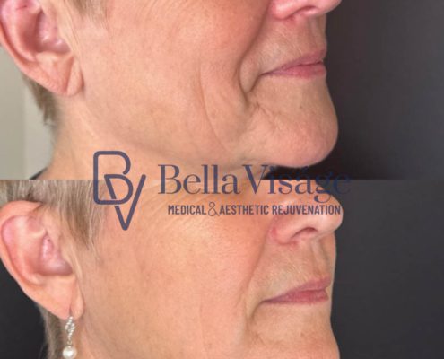 bella-visage-lakeland-rf-b-a-11
