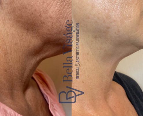 bella-visage-lakeland-rf-b-a-12