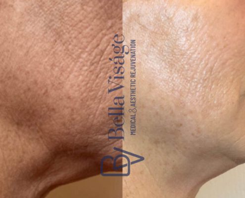 bella-visage-lakeland-rf-b-a-2