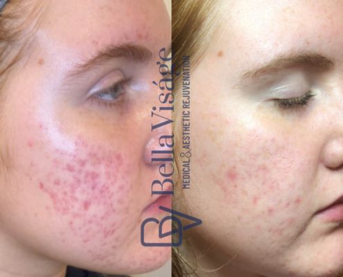 bella-visage-lakeland-rf-b-a-4