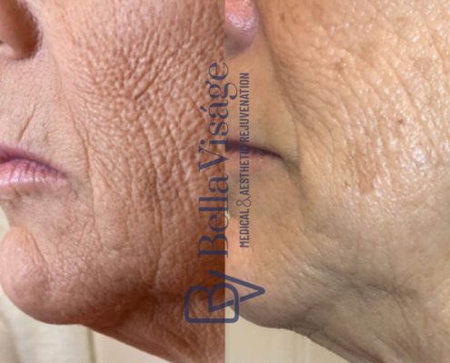 bella-visage-lakeland-rf-b-a-5