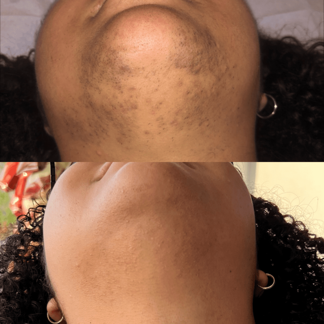 Bella_Visage_Laser_Hair_Removal